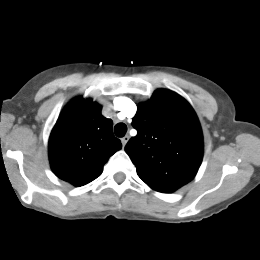 File:Aortic valve non-coronary cusp thrombus (Radiopaedia 55661-62189 B 11).png