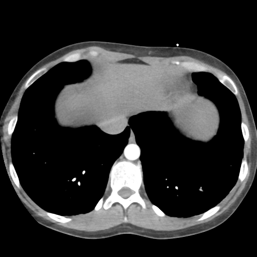 File:Aortic valve non-coronary cusp thrombus (Radiopaedia 55661-62189 B 41).png