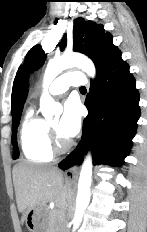 Aortic valve non-coronary cusp thrombus (Radiopaedia 55661-62189 C+ arterial phase 26).png