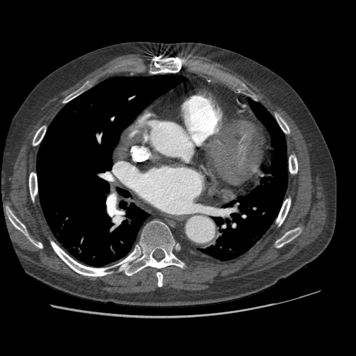 File:Aorto-coronary bypass graft aneurysms (Radiopaedia 40562-43157 A 66).png