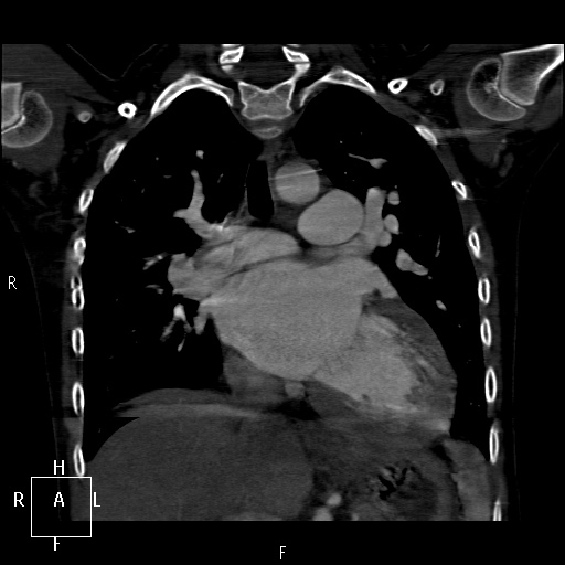 File:Aortopulmonary septal defect (Radiopaedia 41990-45013 Coronal C+ CTPA 32).jpg