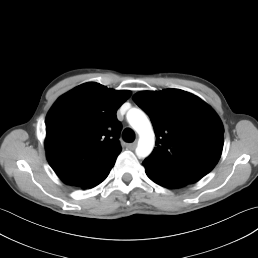 Apical pleural calcification (Radiopaedia 46141-50499 Axial C+ delayed 21).png
