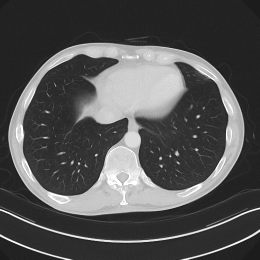 Apical pleural calcification (Radiopaedia 46141-50499 Axial lung window 55).png