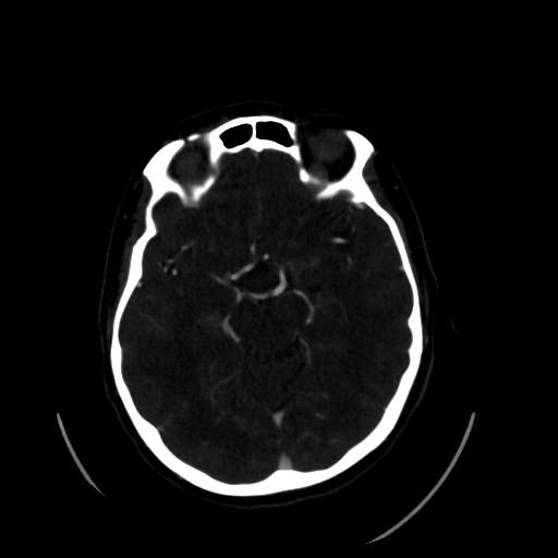 Aplasia of the internal carotid artery (Radiopaedia 61082-68960 A 29).jpg