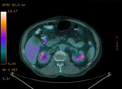 Appendiceal adenocarcinoma complicated by retroperitoneal abscess (Radiopaedia 58007-65041 Axial PET-CT 118).jpg