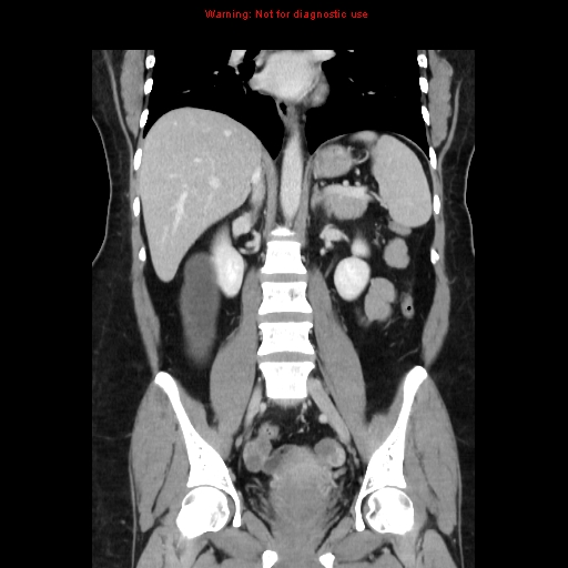 Appendiceal mucinous cystadenoma (Radiopaedia 8263-9111 B 43).jpg