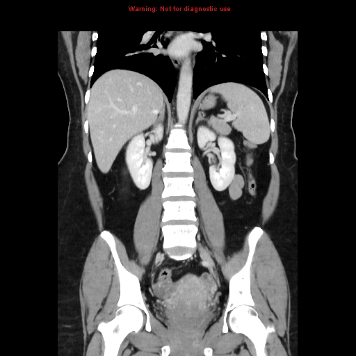File:Appendiceal mucinous cystadenoma (Radiopaedia 8263-9111 B 45).jpg