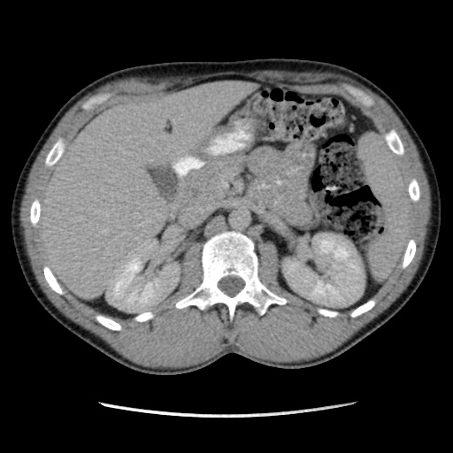 Appendicitis complicated by post-operative collection (Radiopaedia 35595-37113 A 22).jpg