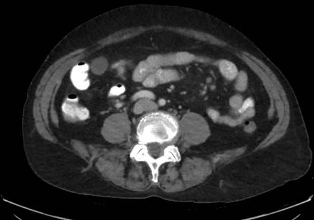 Appendicitis due to chicken fibula (Radiopaedia 74314-85198 A 1).jpg