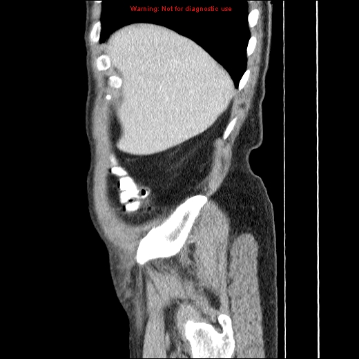 File:Appendicitis mass in inguinal hernia (Radiopaedia 26858-27029 C 4).jpg