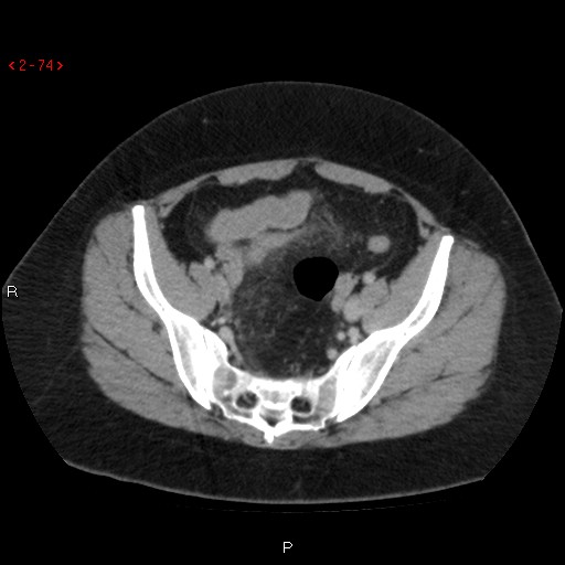 File:Appendicitis with microperforation- promontoric type (Radiopaedia 27268-27442 C 62).jpg