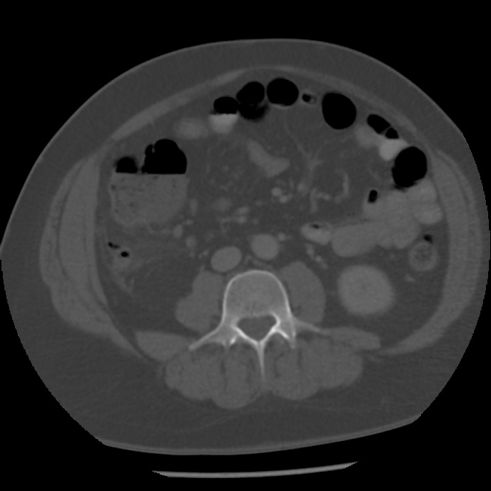 Appendicitis with perforation (Radiopaedia 35790-37342 Axial bone window 28).jpg