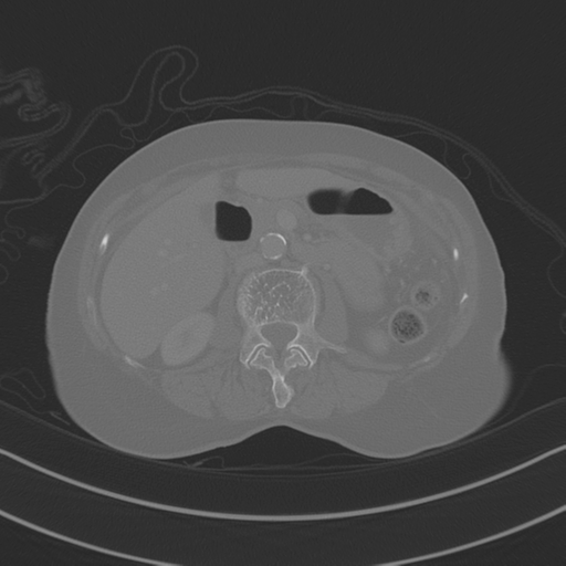April fools' 2019- calcified peritoneal arachnoidosis (Radiopaedia 67273-76636 Axial bone window 15).png