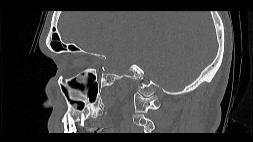 Arcuate foramen (Radiopaedia 89833-106944 Sagittal bone window 21).jpg