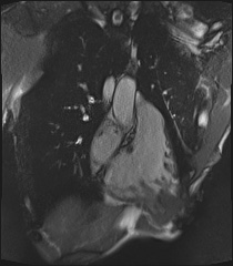 Arrhythmogenic right ventricular cardiomyopathy (Radiopaedia 57972-64966 CINE R2 SSFP 95).jpg