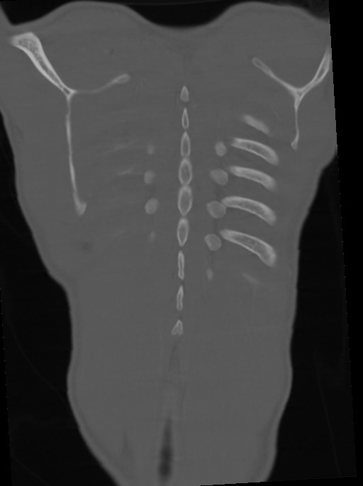 Arrow injury to the neck (Radiopaedia 75225-86323 Coronal bone window 106).jpg