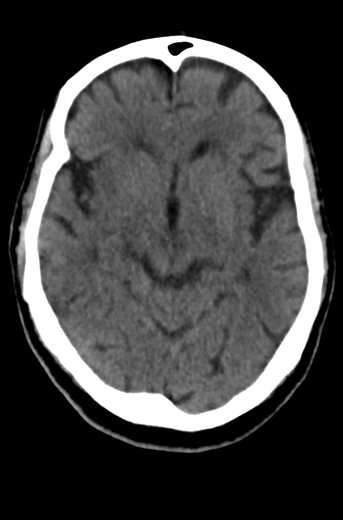 Artery of Percheron infarction (Radiopaedia 80613-94202 Axial non-contrast 86).jpg