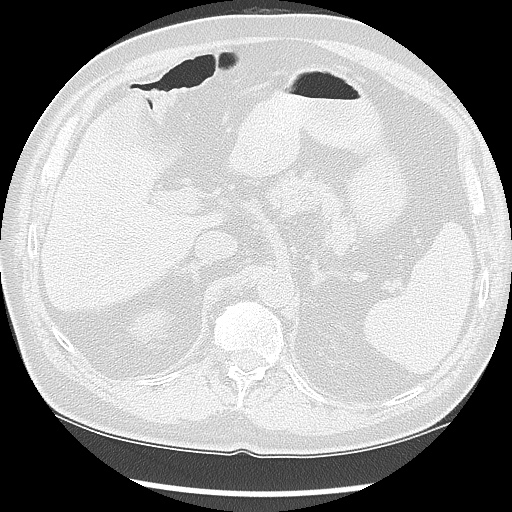 Asbestos-related pleural disease (Radiopaedia 74366-85250 Axial lung window 115).jpg