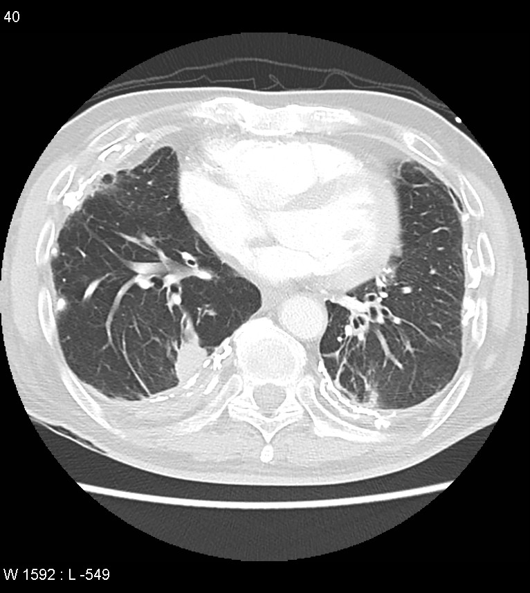 Asbestos related lung and pleural disease (Radiopaedia 14377-14301 A 37).jpg