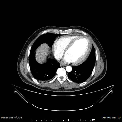 Ascending aortic aneurysm (Radiopaedia 50086-55404 A 71).jpg
