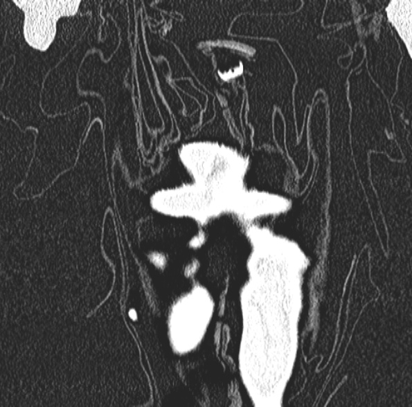 Aspergilloma- with Monod sign (Radiopaedia 44737-48532 Coronal lung window 103).jpg