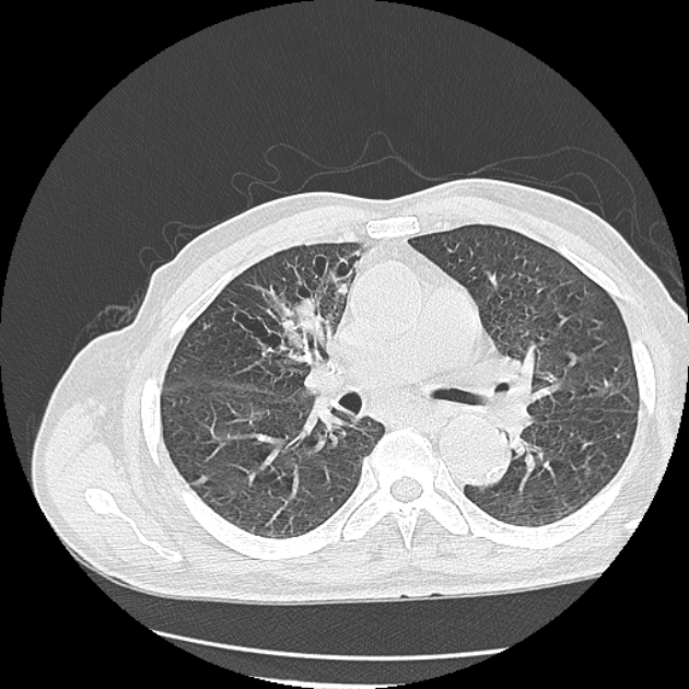 Aspergilloma (Radiopaedia 44592-48327 Axial lung window 37).jpg