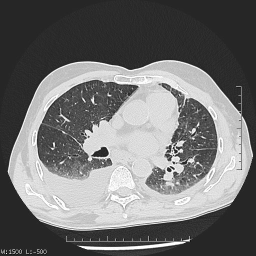 Aspergilloma (Radiopaedia 75184-86270 Axial lung window 26).jpg