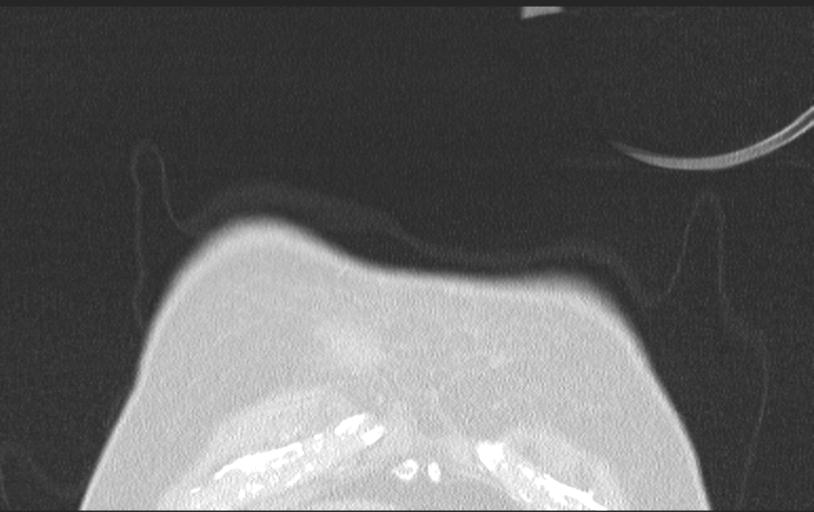 Aspirated tooth (Radiopaedia 28584-28844 Axial lung window 16).jpg