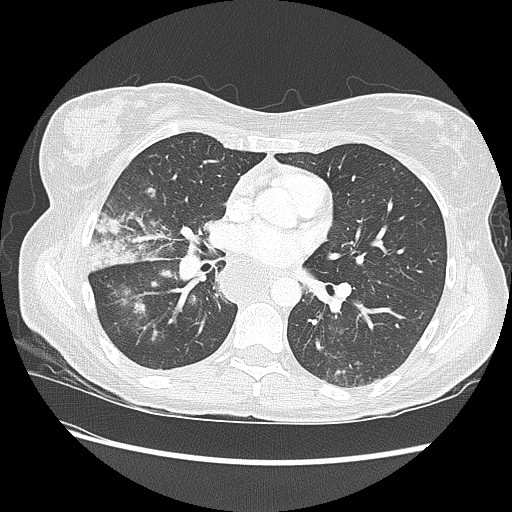 Aspiration pneumonia secondary to laparoscopic banding (Radiopaedia 18345-18183 lung window 56).jpg