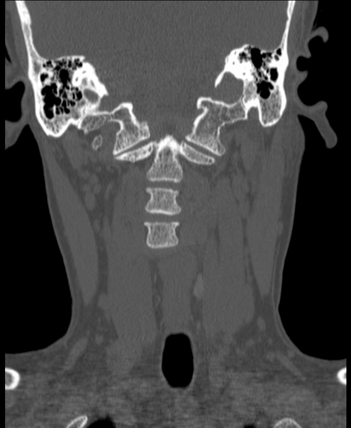 Atlanto-occipital assimilation with basilar invagination (Radiopaedia 70122-80188 Coronal bone window 74).jpg