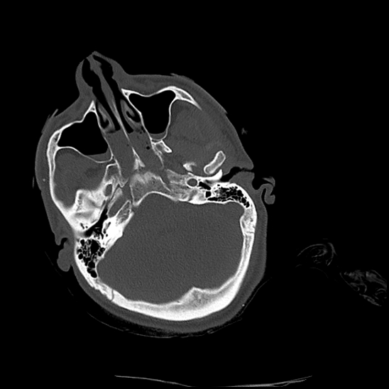 Atlanto-occipital dissociation (Traynelis type 1), C2 teardrop fracture, C6-7 facet joint dislocation (Radiopaedia 87655-104061 Axial bone window 2).jpg