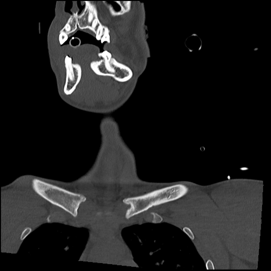 Atlanto-occipital dissociation (Traynelis type 1), C2 teardrop fracture, C6-7 facet joint dislocation (Radiopaedia 87655-104061 Coronal bone window 10).jpg