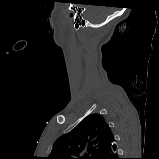 Atlanto-occipital dissociation (Traynelis type 1), C2 teardrop fracture, C6-7 facet joint dislocation (Radiopaedia 87655-104061 Sagittal bone window 61).jpg