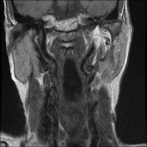 File:Atlantoaxial subluxation - rheumatoid arthritis (Radiopaedia 63564-72199 Coronal T1 5).jpg