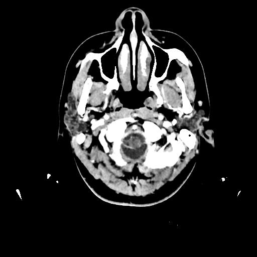 Atretic cephalocele (Radiopaedia 89782-106881 Axial with contrast 14).jpg