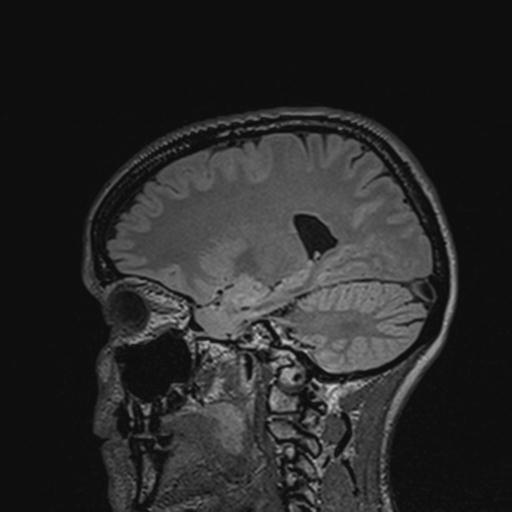 Atretic encephalocoele with inferior vermis hypoplasia (Radiopaedia 30443-31108 Sagittal FLAIR 101).jpg