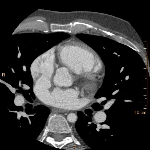 Atrial septal defect (upper sinus venosus type) with partial anomalous pulmonary venous return into superior vena cava (Radiopaedia 73228-83961 A 105).jpg