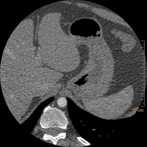Atrial septal defect (upper sinus venosus type) with partial anomalous pulmonary venous return into superior vena cava (Radiopaedia 73228-83961 A 305).jpg