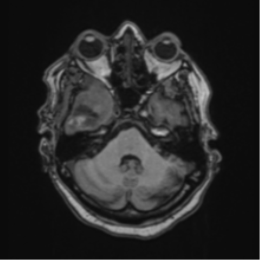 Atypical meningioma (WHO Grade II) (Radiopaedia 54742-60981 Axial T1 17).png
