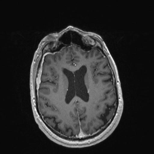 Atypical meningioma (grade II) - en plaque (Radiopaedia 29633-30147 Axial T1 C+ 122).jpg