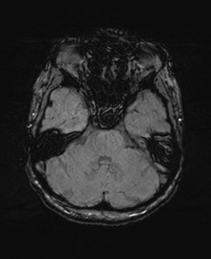 Autoimmune limbic encephalitis (Radiopaedia 30363-31005 SWI 22).jpg