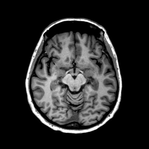Autoimmune limbic encephalitis (Radiopaedia 30363-31005 T1 Axial 1mm 66).jpg