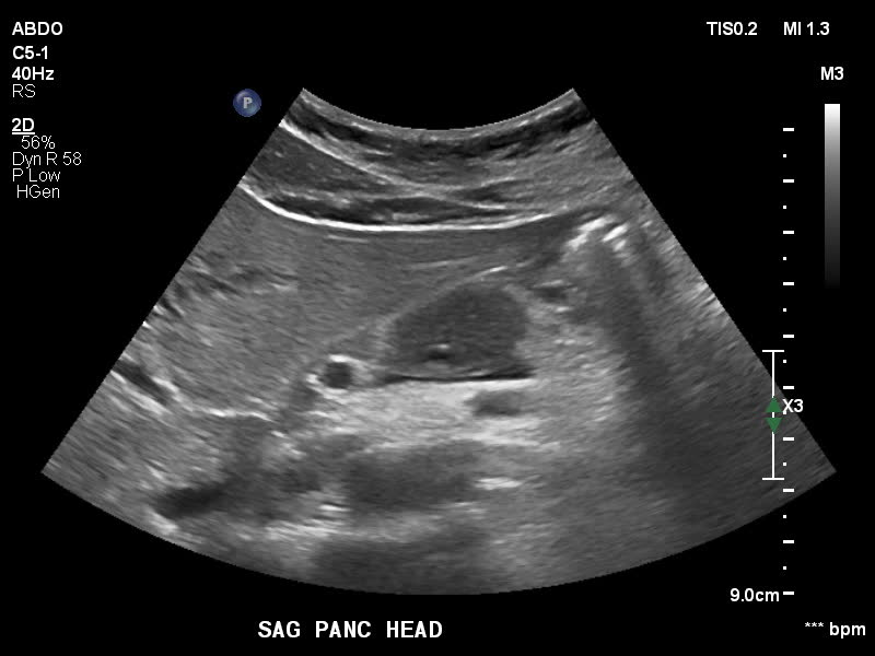 File:Autoimmune pancreatitis (Radiopaedia 88443-105100 C 5).jpg
