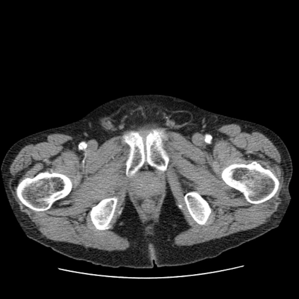 Autosomal dominant polycystic kidney disease (Radiopaedia 27851-28094 B 123).jpg