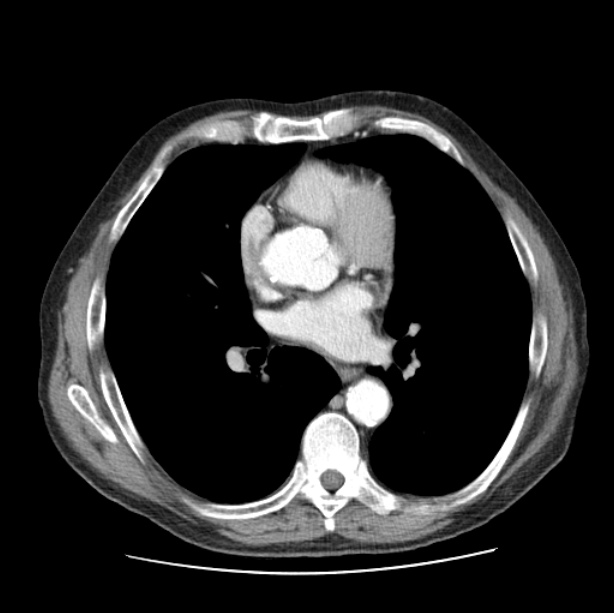 Autosomal dominant polycystic kidney disease (Radiopaedia 27851-28094 B 33).jpg