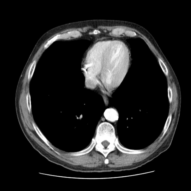 Autosomal dominant polycystic kidney disease (Radiopaedia 27851-28094 B 43).jpg