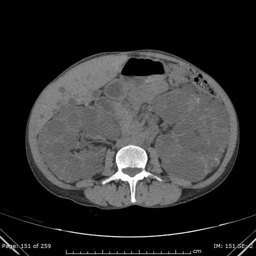 Autosomal dominant polycystic kidney disease (Radiopaedia 44122-47684 Axial non-contrast 54).jpg