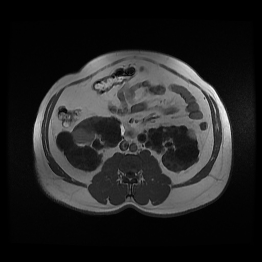 Autosomal dominant polycystic kidney disease (Radiopaedia 50259-55611 Axial 2D Dual Echo 54).jpg