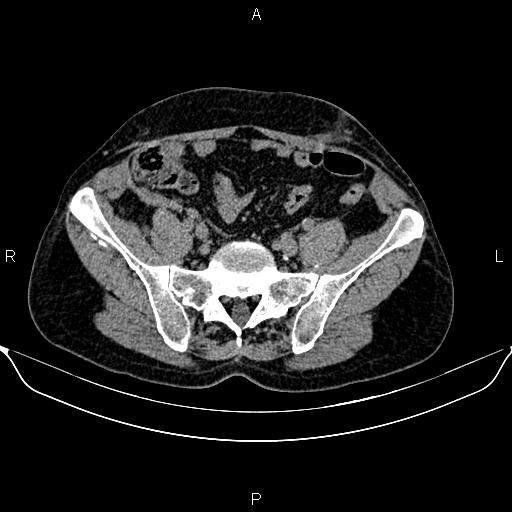 File:Autosomal dominant polycystic kidney disease (Radiopaedia 87830-104287 Axial non-contrast 42).jpg
