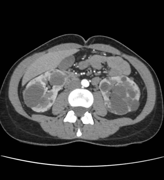 Autosomal dominant polycystic kidney disease - early onset (Radiopaedia 40734-43387 B 36).jpg